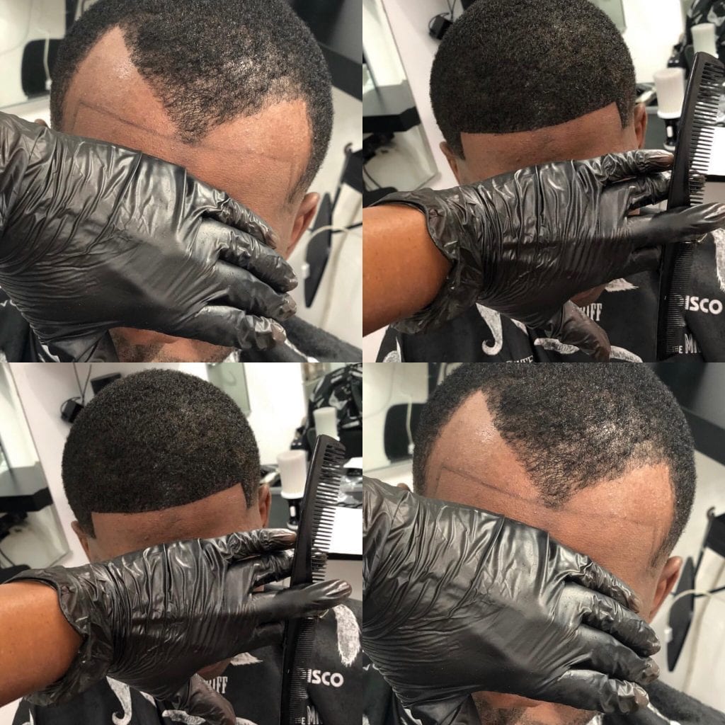 Hair Line restoration New York