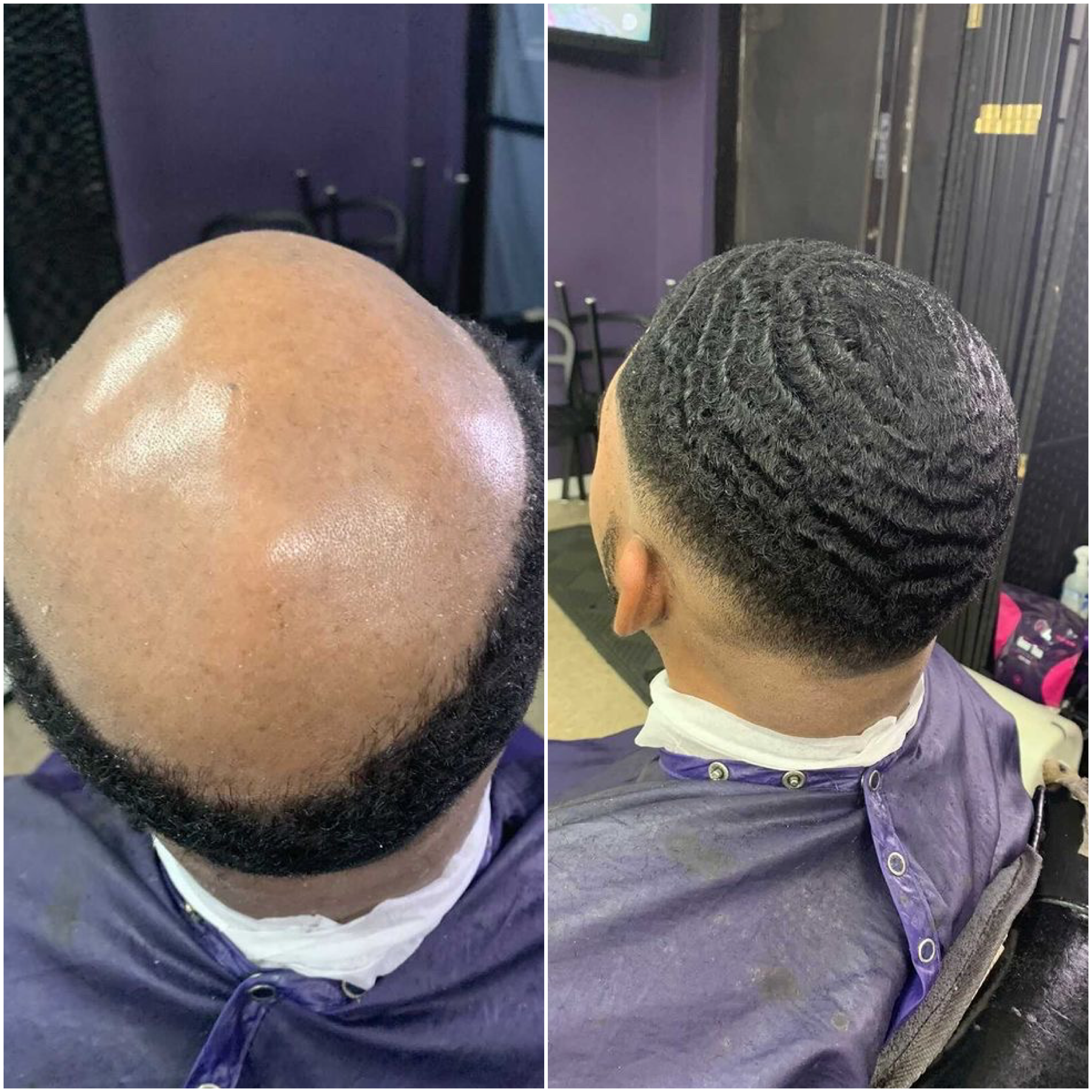 Hair System Dallas before and after
