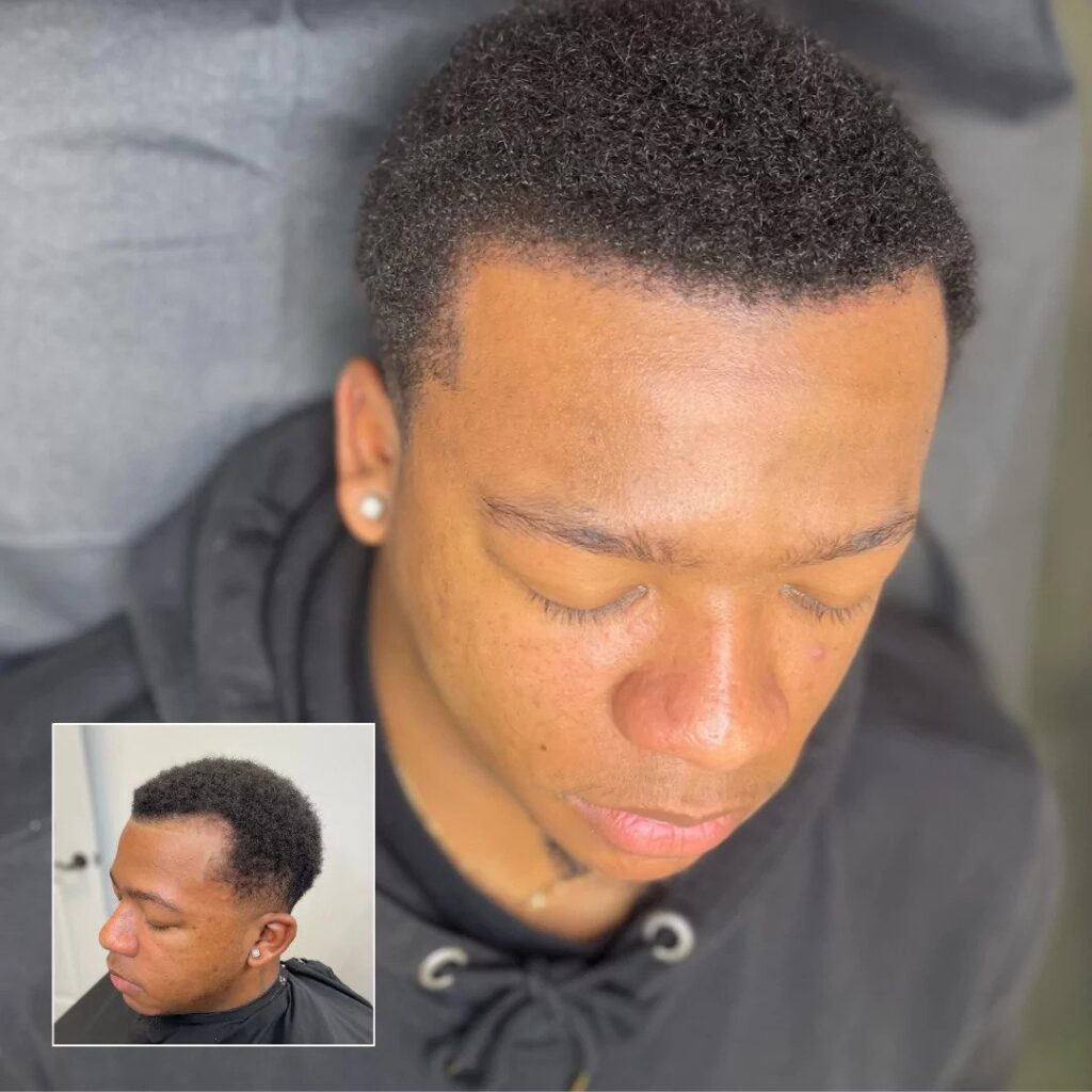 hair line restoration new orleans