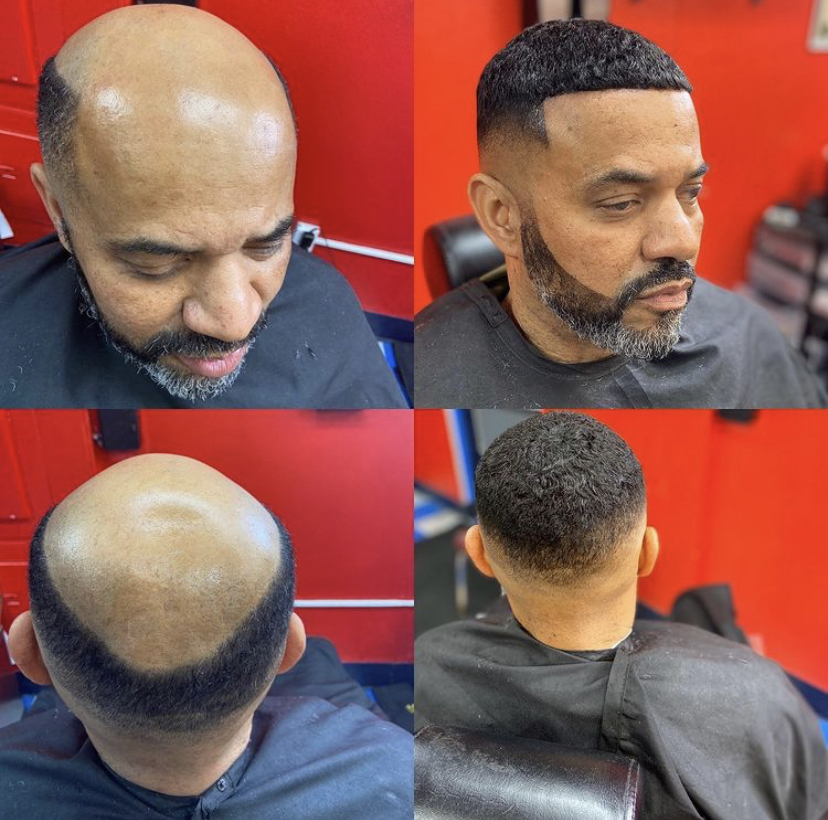 hair loss transformation