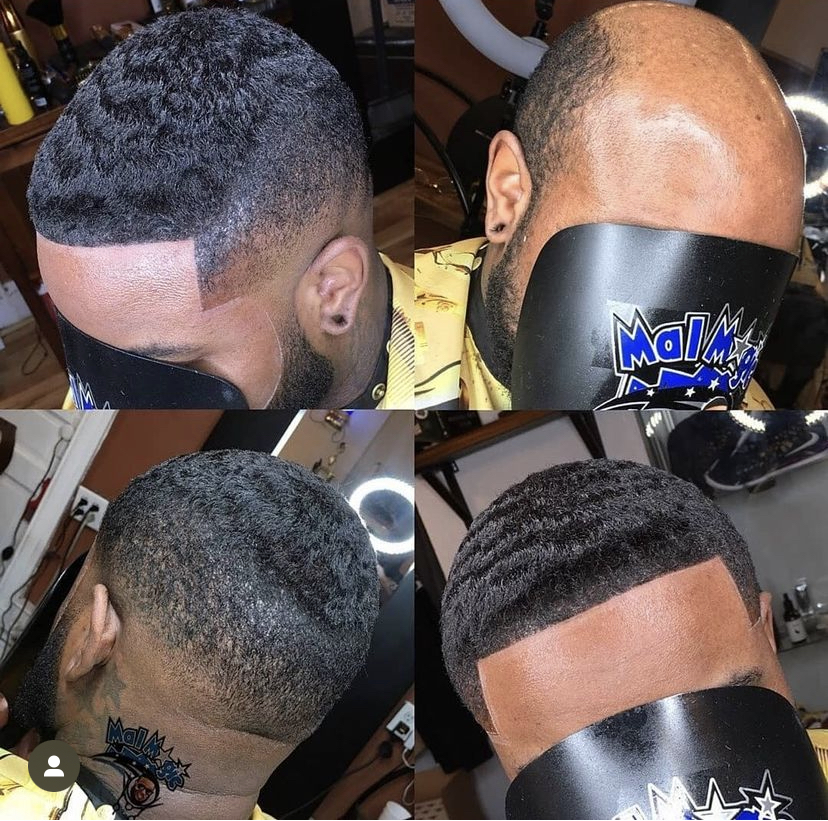 New York Hair replacement before and after